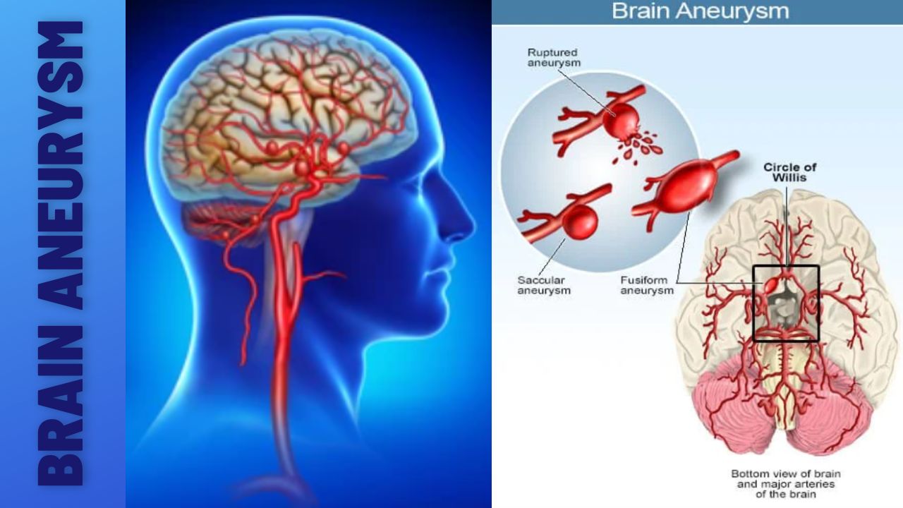 Understanding Brain Aneurysms - Causes, Symptoms, And Treatment ...