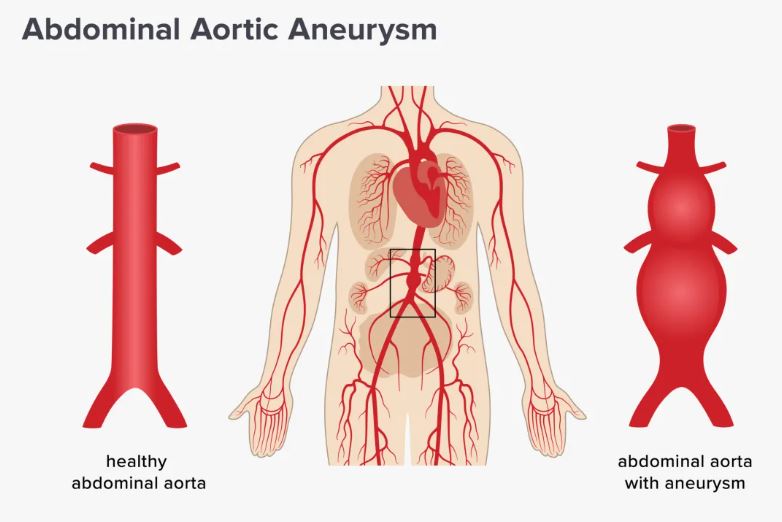 Abdominal Aortic Aneurysms