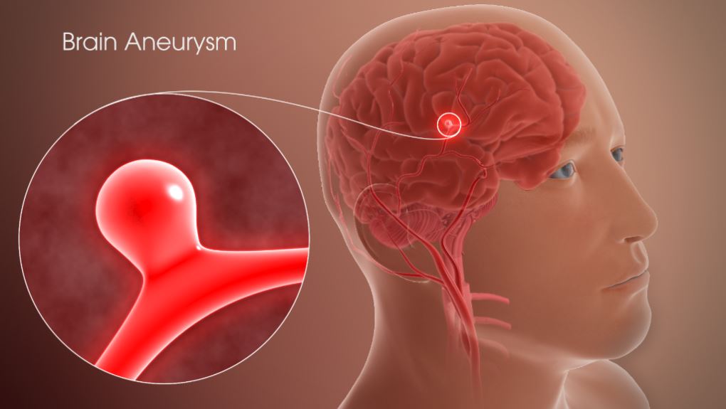 BrainAneurysms