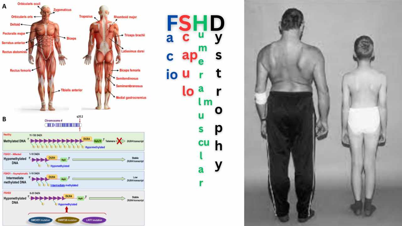 Facioscapulohumeral Muscular Dystrophy (FSHD) Unraveling The Rare