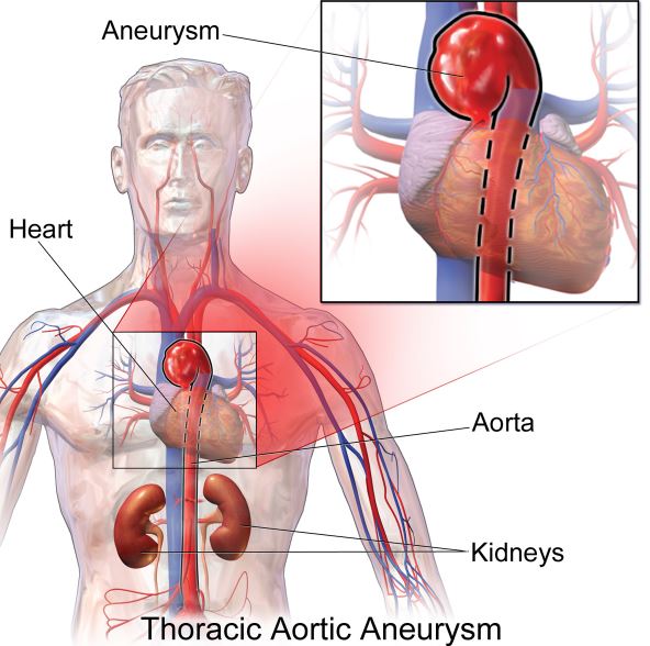 Thoracic Aortic Aneurysms